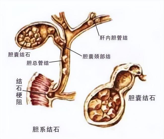 四川保胆案例：德阳胆结石患者成功保胆取石突破传统治疗模式！